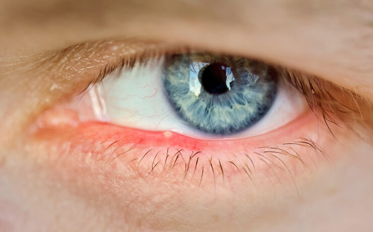 person with itchy irritated eyes