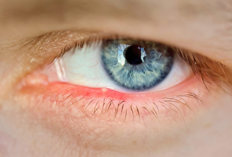 person with itchy irritated eyes